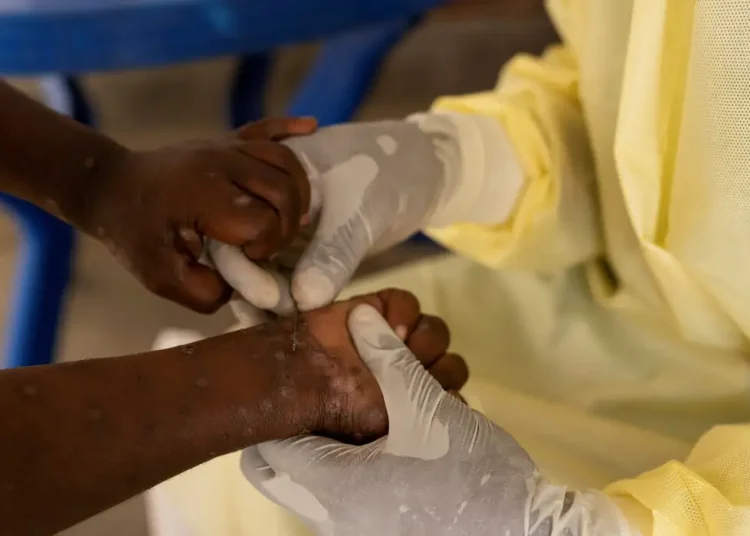 Brasil registra 88 casos de Mpox em 2026; saiba como evitar a doença