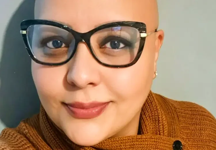 Pacientes com alopecia areata contam trajetória para reaver autoestima